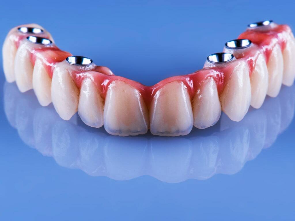 Bridge complet sur implants - Bienvenue à l'espace dentaire de l'Avre
